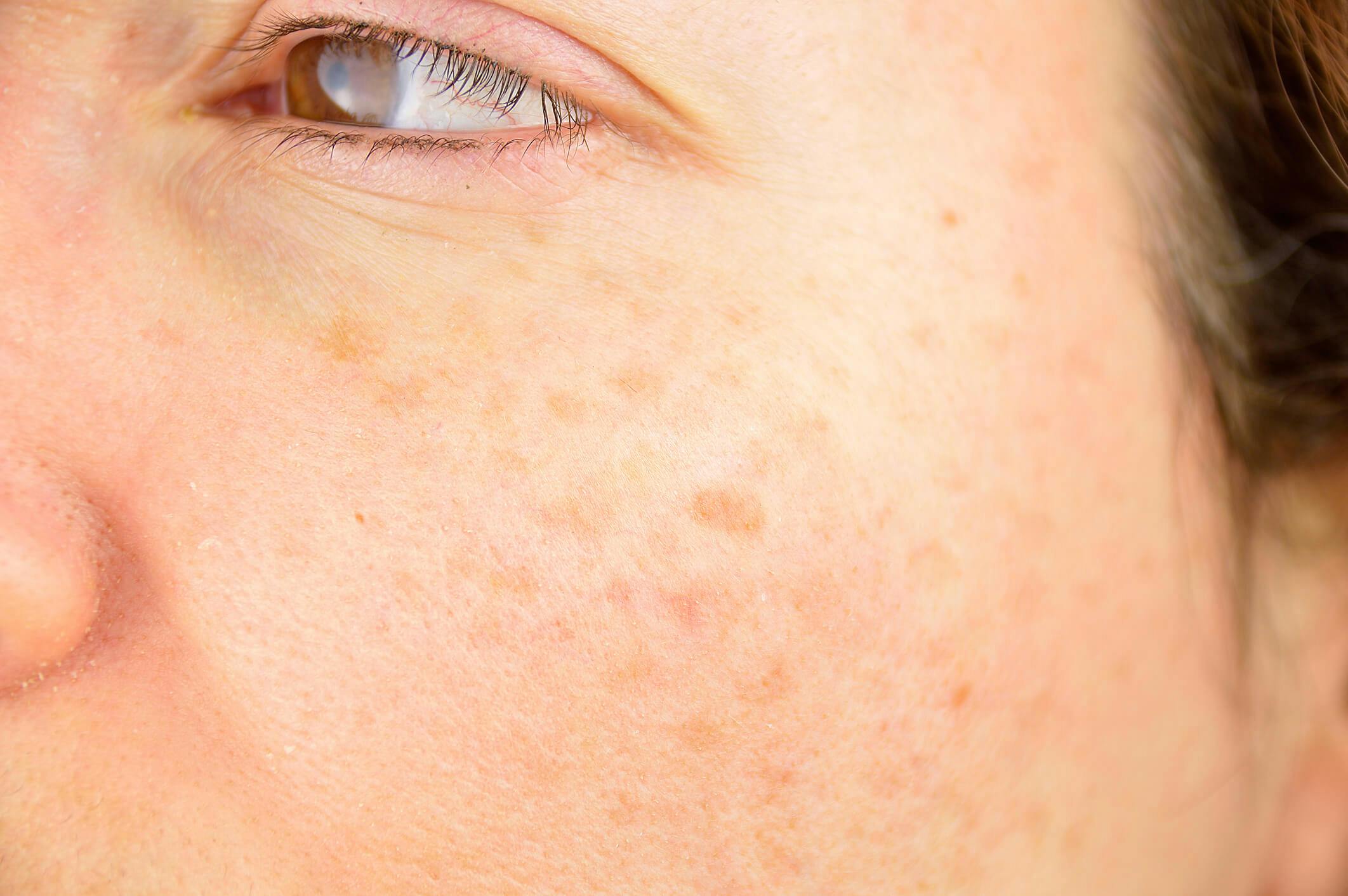 Manchas na pele: quais são as causas e como evitá-las