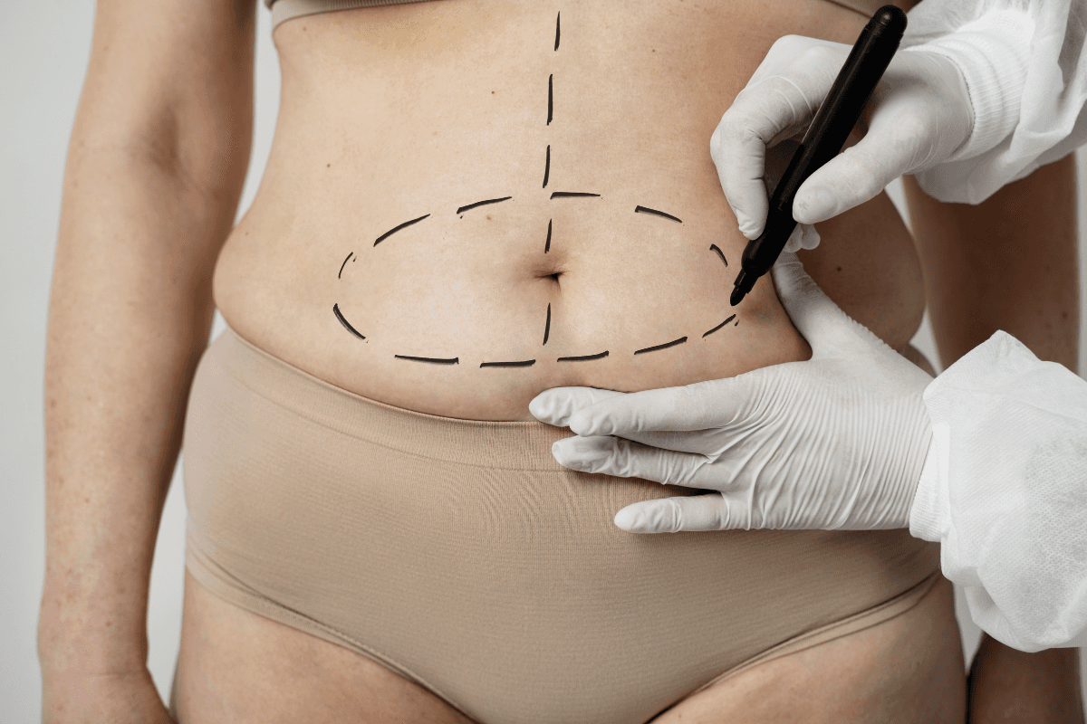 É verdade que existe consórcio para cirurgia plástica?