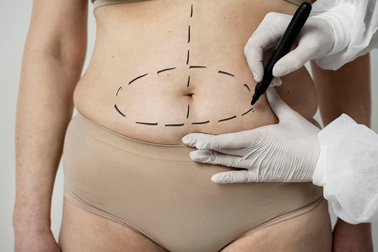 5 motivos para entrar no consórcio de lipoescultura